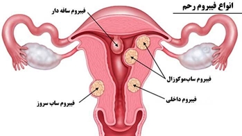 فیبروم‌های رحمی؛ از خون‌ریزی‌های غیرطبیعی تا اختلال در باروری